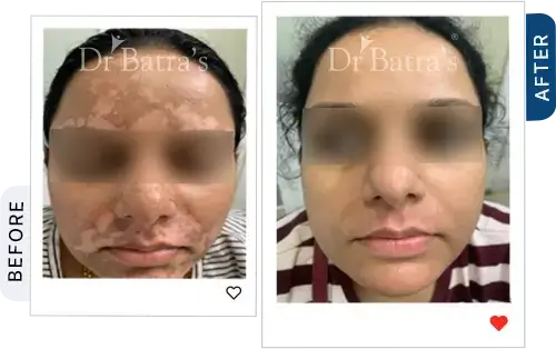 01 Vitiligo Before After