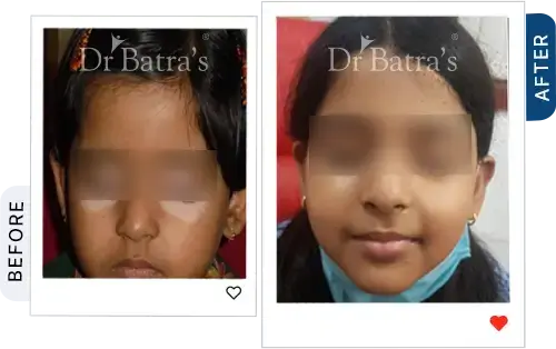 02 Vitiligo Before After