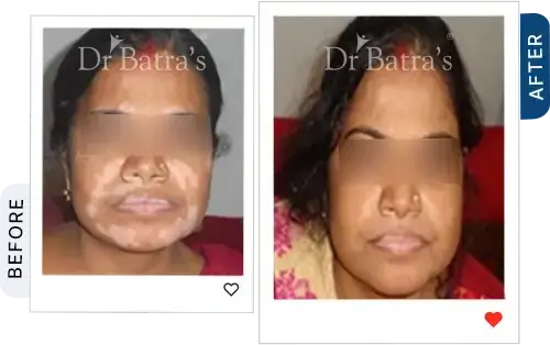 03 Vitiligo Before After