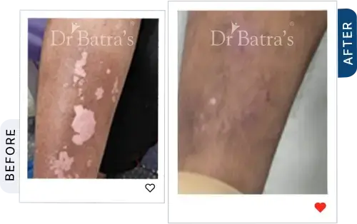 04 Vitiligo Before After
