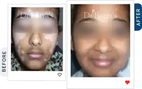 05 Vitiligo Before After