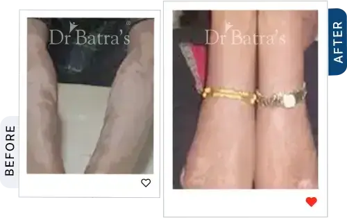 06 Vitiligo Before After