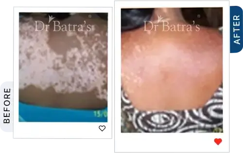07 Vitiligo Before After